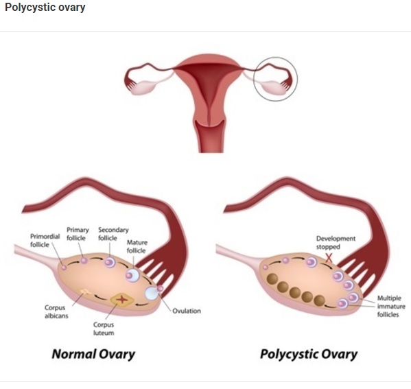 Polycystic ovary syndrome (PCOS, PCOD, PCOS) polycystic, sclerocystic ...