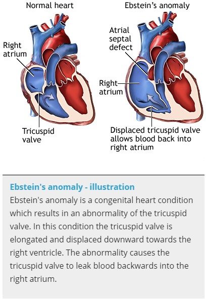 Congenital Heart Disease Arp Webon Netherlands B V
